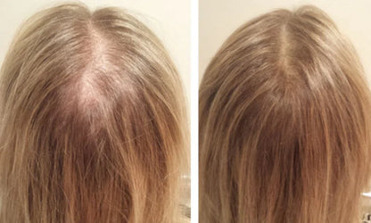 Wireless and Waterproof Scalp Massager